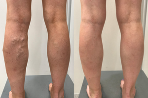 Flebología Endovenosa, Tratamiento Láser para Venas Varicosas, 980nm 1470nm, Eliminación de Venas Varicosas con Láser Mínimamente Invasivo - Product Image 6