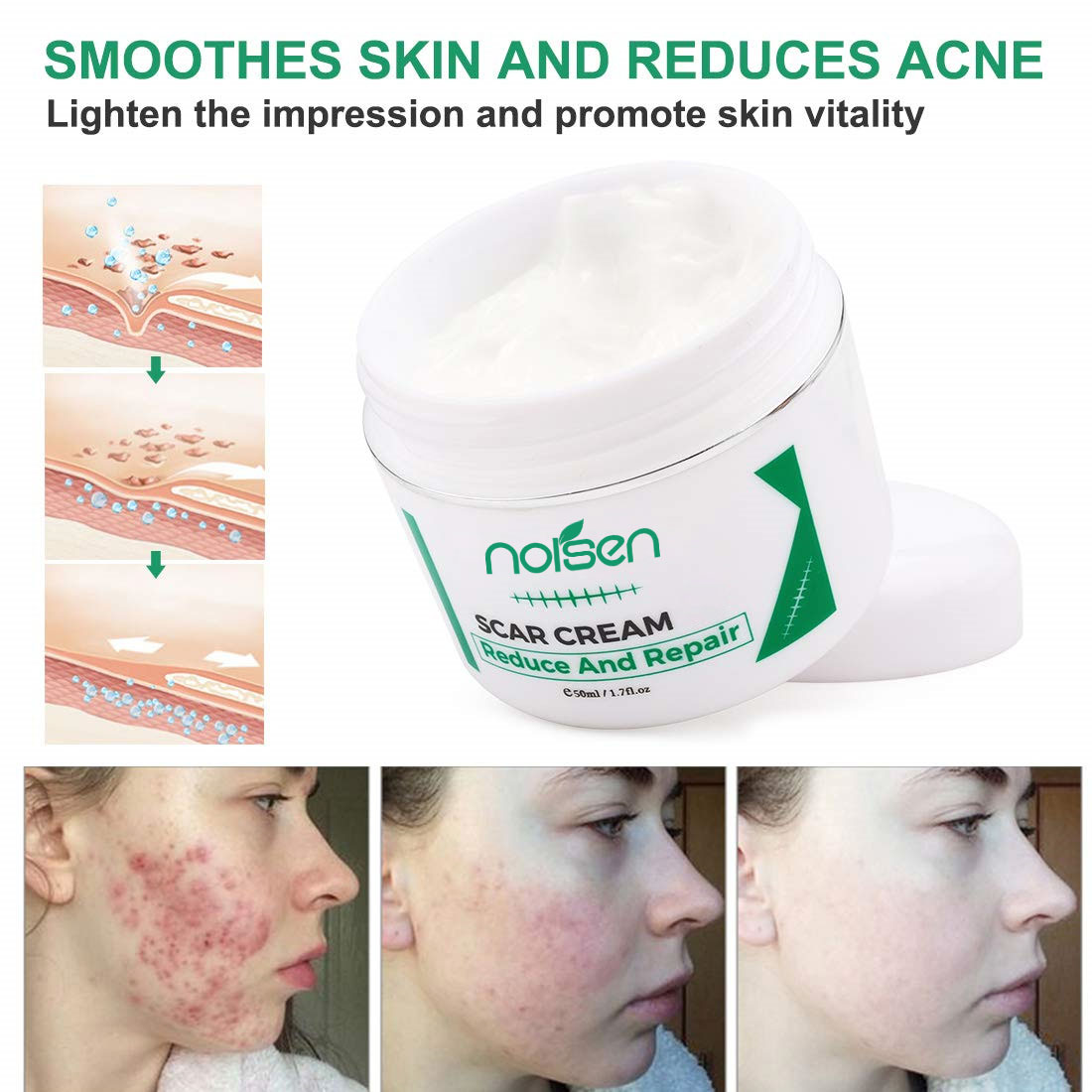 Hot Selling Acne Scar Stretch Marks Remover Cream Skin Repair Face Cream Acne Spots Acne Treatment korea Whitening Cream