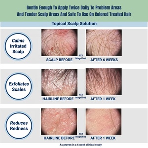 Solución <span class=keywords><strong>para</strong></span> los síntomas de la Psoriasis del cuero cabelludo, espray <span class=keywords><strong>para</strong></span> tratamiento de escamas de enrojecimiento, escamas, grietas, alivio de picazón, Natural, Vegano, nuevo - Product Image 5