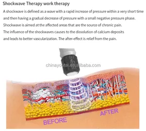 Mesin terapi Shockwave Extracorporeal, peralatan terapi fisik elektromagnetik untuk pijat penghilang rasa sakit