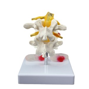 Modelo patológico de columna lumbar FRT038: Modelo humano de dos vértebras lumbares y dos discos intervertebrales enfermos con lesiones lumbares - Product Image 4