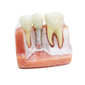 Modèle d'implant triple couronne en argent ; modèle de démonstration de communication dentaire médecin-patient - Product Image 5