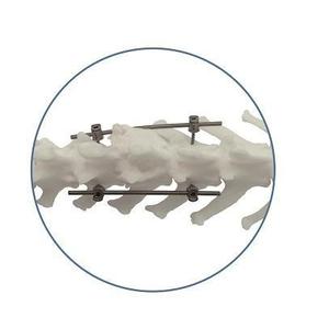 Sistem Fiksasi Sekrup Pedikel Tulang Belakang Berkualitas Tinggi BlueSAO 2.5mm/3.0mm/3.5mm Sekrup Implan Tulang Belakang - Product Image 1