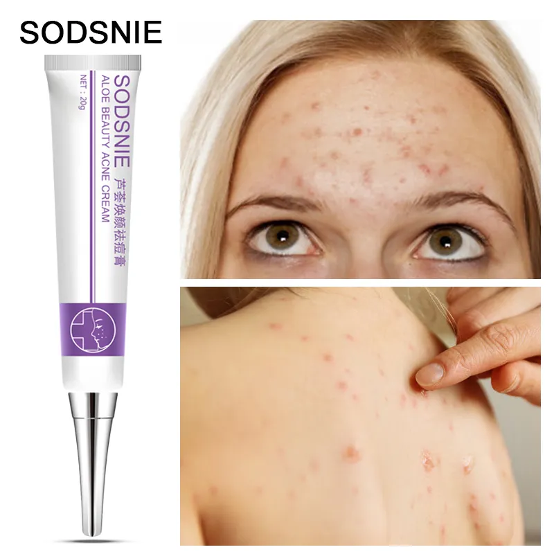 Sodsnie Crème Anti Acne Verbeteren Acne En Maken De Huid Glad En Puistjes Acne Litteken Mark Remover Crème