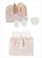 Modèle d'anatomie d'implant dentaire amovible à 3 couches |   Modèle pédagogique pour les étudiants en dentisterie et les cliniques |   Structure Démontable