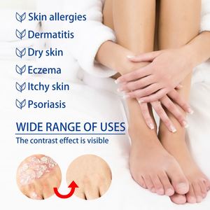 <span class=keywords><strong>Pommade</strong></span> pour le psoriasis South Moon 20g, acné, dermatite, eczéma du scrotum, pityriasis, urticaire, crème de traitement du psoriasis - Product Image 6