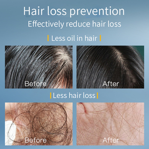 Nhãn Hiệu Riêng 30Ml Người Đàn Ông Của Tóc Dầu Và Huyết Thanh Bán Buôn Chống-Rụng Tóc Và Điều Trị Tăng Trưởng Tự Nhiên Hữu Cơ Cho Tóc Hói - Product Image 2
