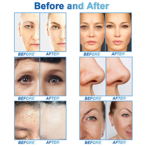 جهاز علاج الوجه وتجديد البشرة بسعر المصنع متعدد الوظائف 15 في <span class=keywords><strong>1</strong></span> هيدرا - Product Image 6