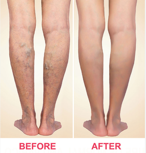 980nm + 1470nm Laser dioda varises EVLT EVLA perangkat ablasi vena perawatan kaki varises - Product Image 6