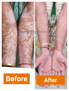 Lámpara UVB KN-4003BL 9w 311nm, Dispositivo de Fototerapia PUVA para el Tratamiento del Vitiligo y la Psoriasis, Lámparas UVB para Vitiligo - Product Image 2