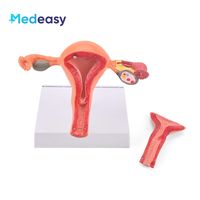 Modelo de anatomía del útero y ovario femenino Medeasy, modelo de útero normal y con enfermedades, con base desmontable para la enseñanza de enfermería médica