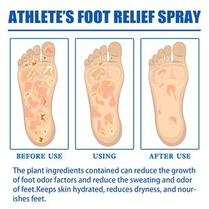 Aerosol antihongos <span class=keywords><strong>para</strong></span> el cuidado del <span class=keywords><strong>pie</strong></span> del <span class=keywords><strong>atleta</strong></span> a base <span class=keywords><strong>de</strong></span> hierbas <span class=keywords><strong>de</strong></span> alta calidad, fórmula Natural <span class=keywords><strong>para</strong></span> aliviar el dolor, antipicazón, pelado <span class=keywords><strong>de</strong></span> piel muerta - Product Image 6