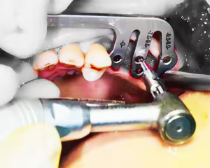 แผ่นนำรากฟันเทียมไม้บรรทัดบอกตำแหน่งการเจาะและเครื่องมือจัดตำแหน่งเหมาะสำหรับห้องปฏิบัติการทางทันตกรรม - Product Image 4