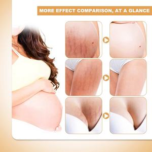 Crema para el Cuidado de la Piel de Marca Privada, Crema de Mango para <span class=keywords><strong>Eliminar</strong></span> Estrías del Embarazo, Crema Anti-Estrías - Product Image 5