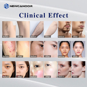 Máquina de Depilación Láser BBL de Alta Calidad con 6 Filtros y Rejuvenecimiento Facial, 2 Cabezales Magnéticos, Utilizada en Salones de Belleza - Product Image 5