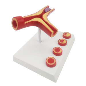 Demonstrador de Arteria Tipo Y DARHMMY - Material de PVC con Aterosclerosis y Trombosis para Educación y Entrenamiento Médico - Product Image 1