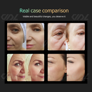 Dispositivo 3 in 1 EMS RF <span class=keywords><strong>Hifu</strong></span> Liposonics 360 Max 25D, Ultrasuoni Focalizzati ad Alta Intensità per Rassodamento della Pelle, Anti-Invecchiamento, Scrubber Cutaneo - Product Image 6