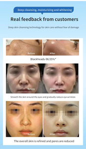 Máquina Facial Multifuncional Portátil de Hidrodermoabrasión ABS para Limpieza Profunda y Reducción de Poros - Product Image 3