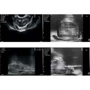 Precio de fábrica 128 elementos 3 en 1 biplano inalámbrico Color Doppler ultrasonido microconvexo Sonda de matriz lineal para Urología - Product Image 4