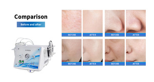 Multifunctional High Frequency Oxygen Jet Peel Hydro Dermabrasion Blackhead Remover Vacuum Facial Machine Touchscreen 2-Year - Product Image 4