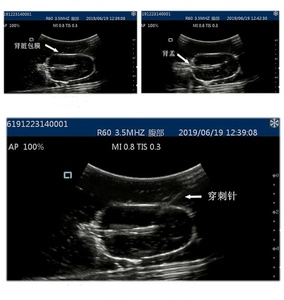 Modelo de punción <span class=keywords><strong>renal</strong></span> guiada por ultrasonido de ciencia médica para enseñar modelo de entrenamiento de intervención <span class=keywords><strong>renal</strong></span> por ultrasonido - Product Image 6