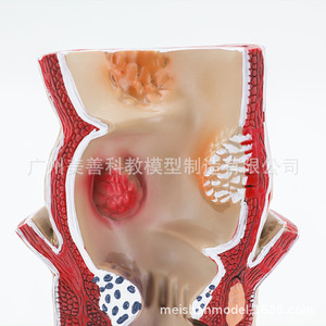 Modèle de hémorroïdes rectales et de lésions colorectales ; hémorroïdes rectales internes et externes et modèle anorectal ; pathologie rectale. - Product Image 2