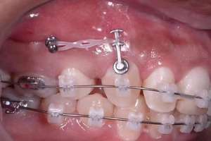 Prezzo di fabbrica di alta qualità Smile-orto anticipo apparecchio dentale ortodontico legabile doppi ganci linguale bottoni 9.83mm - Product Image 5