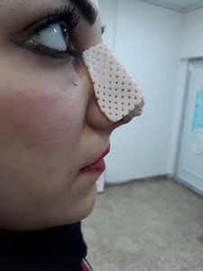 <span class=keywords><strong>Aquaplast</strong></span>-láminas de férula Nasal, férula termoplástica externa para la nariz, rinoplastia, cuidado de la nariz - Product Image 3
