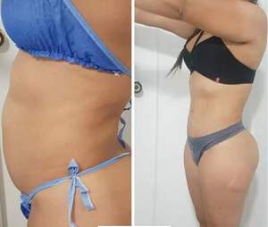 Triangel Laseev plastik cerrahi fiberlift lazer liposuction güç kanül güç kanül kolu 980nm facelifting lazer - Product Image 5