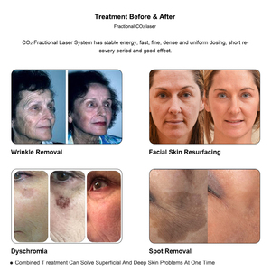 Macchina <span class=keywords><strong>Laser</strong></span> Frazionale CO2 Professionale 2026 per Cicatrici da Acne, Multifunzionale per Rassodamento Cutaneo e Vaginale - Product Image 6