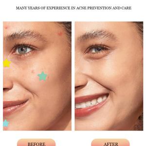 Venta al por mayor de fábrica: 40 parches coloidales multicolor en forma de estrella para acné y espinillas, uso diurno y nocturno - Product Image 5