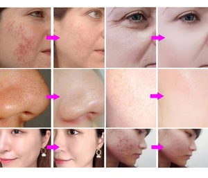 Dermashine PRO Máquina de Mesoterapia Manual de 9 Pines con Succión al Vacío para Blanqueamiento de Piel, Rostro, Nariz, Ojos, Labios y Cabeza EU/ZA/US/UK - Product Image 6