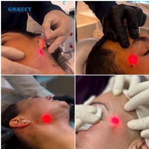 एंडोलेज़र मशीन 635 980 1470 डायोड लेजर लिपोलिसिस वसा हटाने - Product Image 6