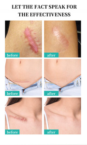 ครีมลบรอยแผลเป็นจากสิว รอยแตกลาย ครีมซ่อมแซมผิว รอยสิว จุดด่างดำ รักษาสิว ครีมลด<span class=keywords><strong>สิว</strong></span>เสี้ยน ครีมฟอกสี 50 มล. - Product Image 2