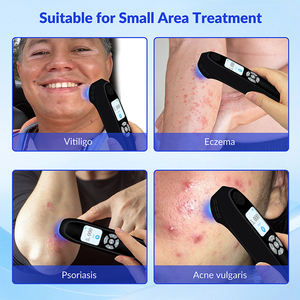 Equipo de Radiación Ultravioleta B con Láser Excimer de 308nm Portátil, Tratamiento para Psoriasis, Vitíligo y Eccema - Product Image 3
