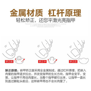 Toenail Corrector Straightener Nail Wire Pedicure Tool Silver Gold Color <b>Box</b> Portable Simple Style - Product Image 5