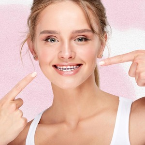 Modieuze beugels voor tanden, decoratieve beugels, orthodontische beugels, kleurrijke beugels voor volwassenen en tieners - Product Image 6