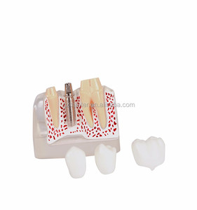 4 volte la scienza medica impianto dentale modello porcellana denti amovibile corona ponte impiallacciature per l'insegnamento di materiale plastico - Product Image 6