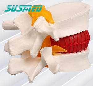 Modèle de démonstration de hernie discale lombaire humaine modèle d'enseignement de l'anatomie de la pathologie discale - Product Image 2