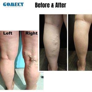 Dispositivo Láser EVLT GOMECY 1940nm 635nm <span class=keywords><strong>para</strong></span> Clínica Médica Estética y Vascular, Equipo Láser de Alta Potencia - Product Image 3