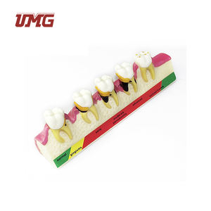 Tandheelkundige Studiemodellen Classificatiemodel Parodontitis - Product Image 6