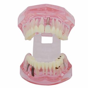 1 modèle dentaire d'étude et de démonstration d'implant dentaire avec restauration, rose - Product Image 4