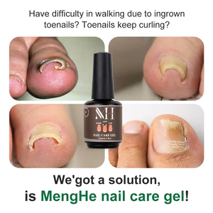 Menghe-kit de pedicura, corrector de uso especial, gel duro uv para manicura y pedicura, producto para uñas encarnadas, nueva fórmula - Product Image 2
