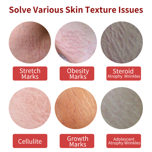 Creme para Remoção de Estrias Pós-parto para Homens e Mulheres, Tratamento Anti-Estrias para Uso em Salão - Product Image 3