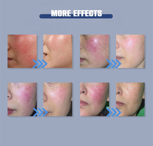 Profsessional 980nm Diode <strong>Laser</strong> Vascular Removal <strong>Machine</strong> High Frequency <strong>Laser</strong> Removal Blood Vessels Beauty <strong>Machine</strong> - Product Image 6