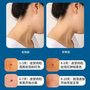Skin Tag <b>Removal</b> Kit With Alcohol Pads For Neck And Armpits Quick Effective Treatment - Product Image 4
