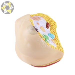 Modèle anatomique du <span class=keywords><strong>cancer</strong></span> du sein féminin dans la section transversale modèle de médecine du sein pathologique - Product Image 3