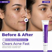 Crema para el Acné con Peróxido de Benzoilo al 5% de Fábrica, Tubo de 45g, Marca Privada OEM, Gel para el Cuidado Facial Anti-Espinillas y Eliminación de Manchas para Piel Grasa con Acné