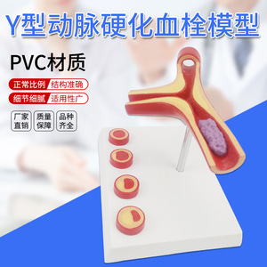 Modelo de arteria en forma de Y con aterosclerosis y trombosis, modelo educativo, suministros del fabricante. - Product Image 4