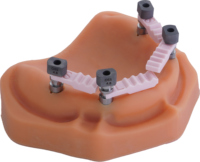 Scanbody dentaire multi-unité compatible avec Straumann pour impression numérique intra-orale et laboratoire dentaire CAD/CAM